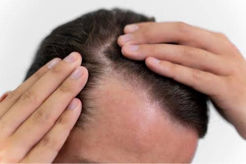 is hair transplant safe